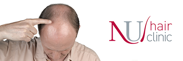 Mesotherapy Treatment Men Uk Non Surgical Hair Loss Solution